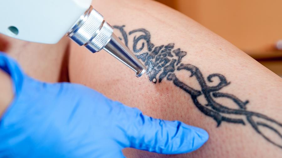 Clarinval : Enlèvement des tatouages uniquement par des médecins